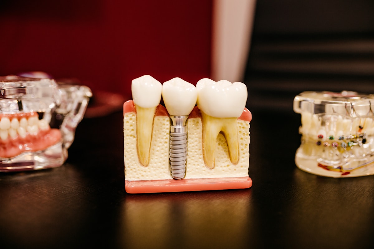 Diş implantı modelinde, implant sonrası beslenmenin önemini gösteren sağlıklı diş yapısı.